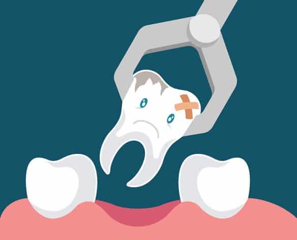 tooth-extraction-585x472